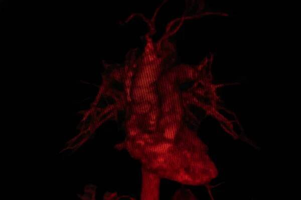 cat scan obrázek plicní angiografie ukazující adenokarcinom plic - ct scan lung - stock snímky, obrázky a fotky