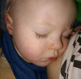 Syn 14 měsíců náhlá vyrážka, která se stěhuje, mizí a zase objevuje