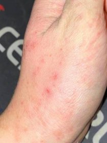 Alergie a ekzémy | Ekzem na těle