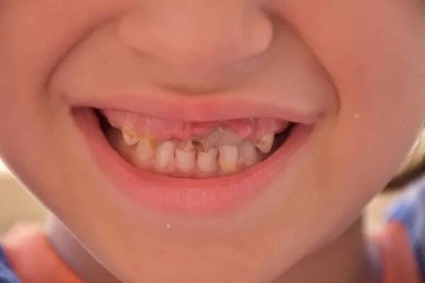 Špatné zuby v dítěti a caries, — Stock obrázek
