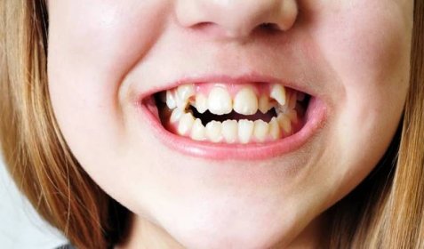 Na mléčných zubech nezáleží aneb mýty o dětském chrupu