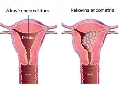 Rakovina endometria - ilustrace