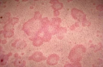 Paraziti způsobující alergie: může dojít k alergické reakci od helmintů