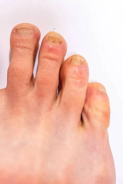 detail dospělé mužské nohy se třemi malými prsty infikovanými mykózou nehtů (onychomykóza). - bad pedicure - stock snímky, obrázky a fotky