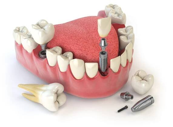 Zubní implantát lidské. Zubní koncept. Lidské zuby nebo zubní protézy. — Stock obrázek