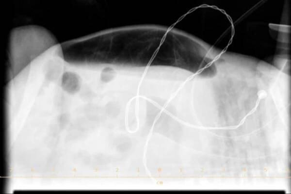 Česká Neonatologická Společnost • RTG abdomen 07 pneumoperitoneum