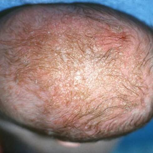 cradle cap on baby pictures