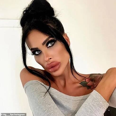 But as Botox and filler is only temporary, Tara needs to return to the doctor every few months in order to maintain the plump-lip look