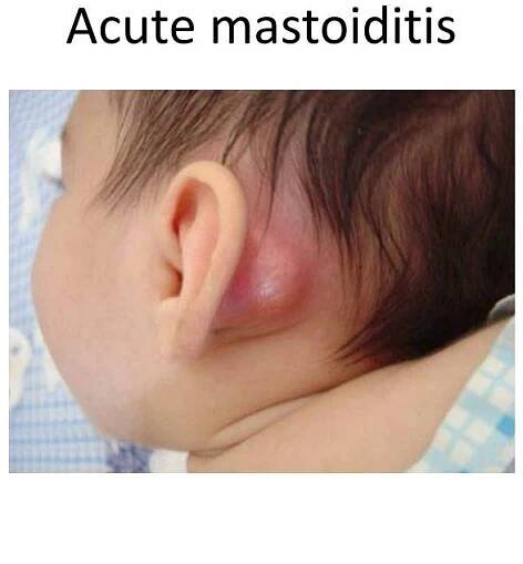 PPT - OTITIS MEDIA (OM) PowerPoint Presentation, free download - ID:2185186