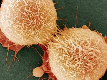 Cancer Is Partly Caused By Bad Luck, Study Finds