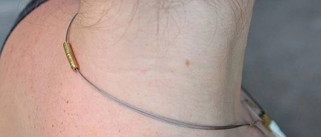 Papilomy na krku: příčiny, typy, hardwarová léčba a alternativní metody