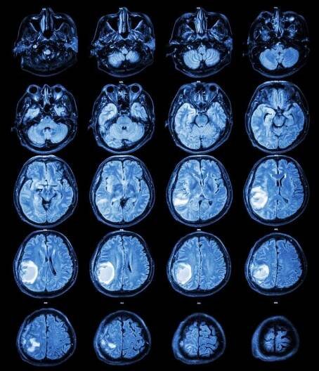 Common Myths and Facts about Brain Tumors - Houston Neurosurgery & Spine