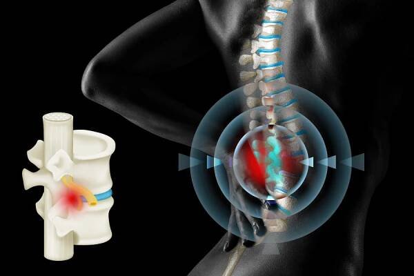 Výhřez ploténky? Řešením může být endoskopická operace - EuroPainClinics