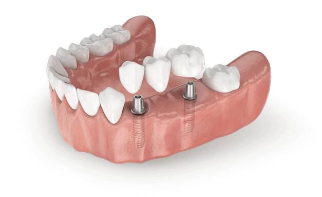 náhrada třech zubů pomocí implantátu
