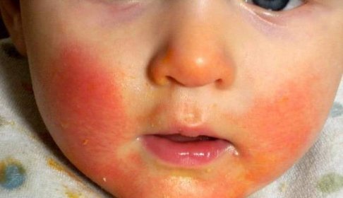 alergické reakce u dětí