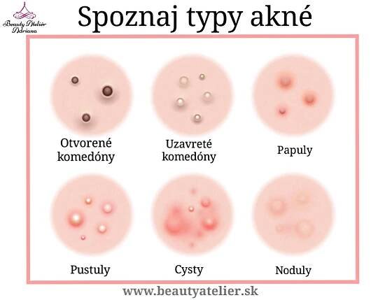 Spoznaj typy a prejavy akné a vyber pre svoju pleť správne ošetrenie. | Beauty Ateliér Adriana