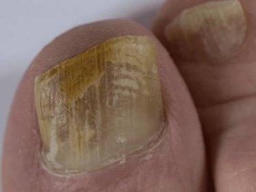 How to Get Rid of a Fungal Nail Infection Using Tea Tree Oil