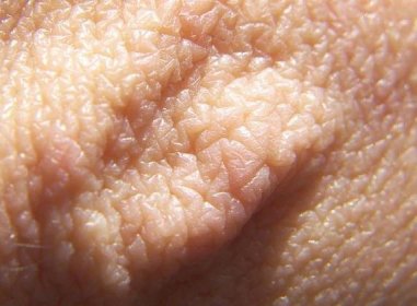Patofyziologie snadno zranitelné kůže | Léčba rány