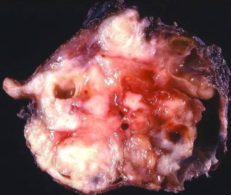 Soubor:Inflammatory pseudotumor myofibroblastic tumor (5569144820).jpg