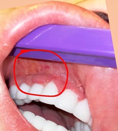 Hrozivý zážitek z turecké kliniky. Žena má zničených 8 zubů a trápí ji bolesti