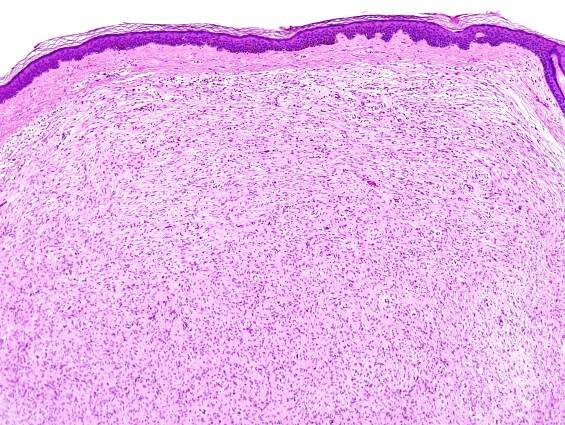 Neurofibrom