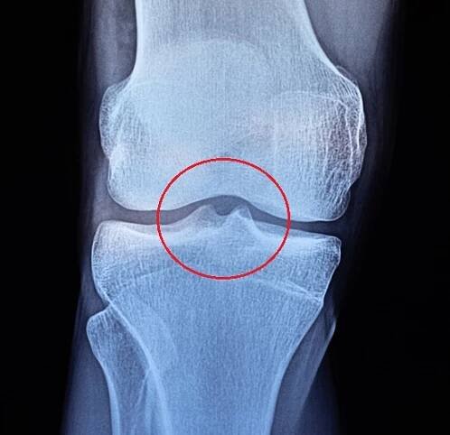 osteoidní osteom