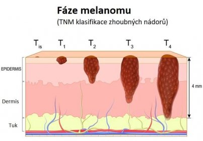 Fáze melanomu - ilustrace