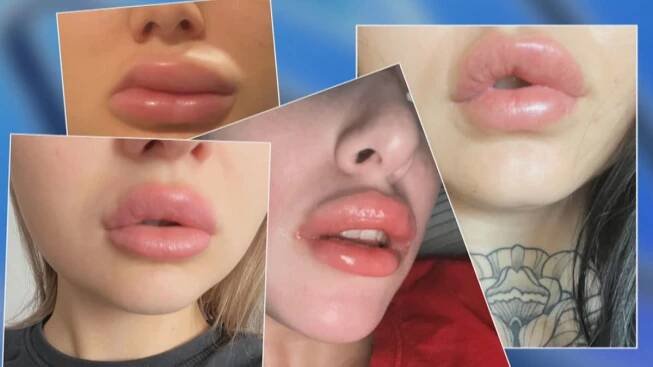 Opuchlé rty, deformace a bolesti. V Česku přibývá falešných plastických klinik