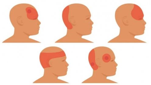 Každá bolest hlavy není migrénou. Zjistěte, jaké typy bolestí existují, jak se jednotlivé druhy léčí a který typ je nejzávažnější