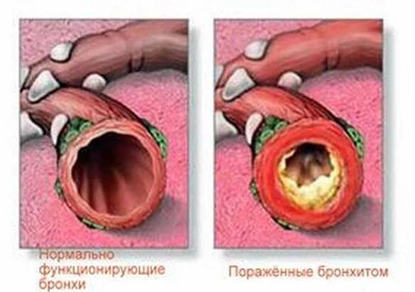 Příčiny, p�říznaky a léčba chronické bronchitidy / Bronchitida