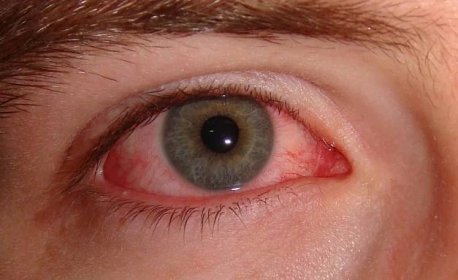 Koronavírus spôsobuje aj zápal ciev a začervenané oči. Problémy majú hlavne mladí