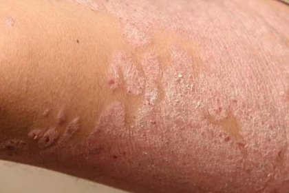 Nemoci způsobené abnormalitami lymfy. Psoriáza je kožní onemocnění. — Stock obrázek