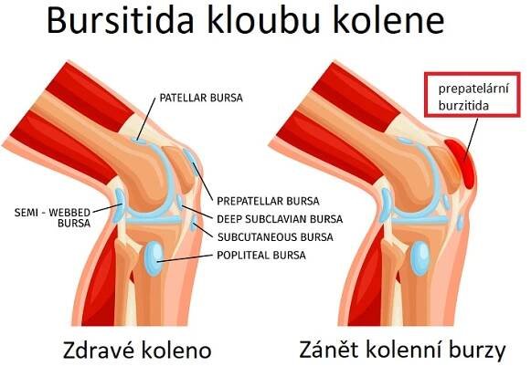 Bursitida kolene - ILUSTRACE