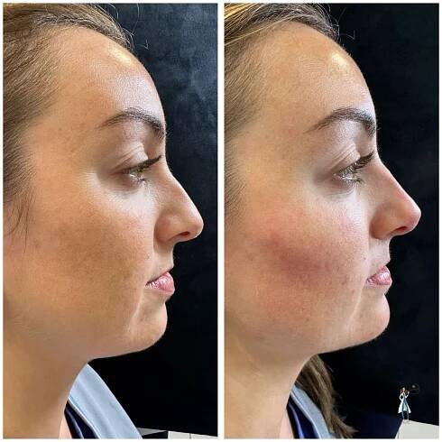 Dermal Filler Nose Before and After | SeaMist MedSpa in Rhode Island