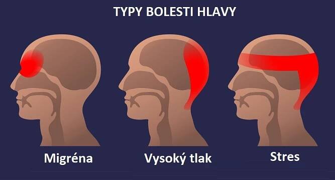 Zjistěte, jak se zbavit intenzivní bolesti hlavy za méně než 5 minut bez nutnosti užití prášků