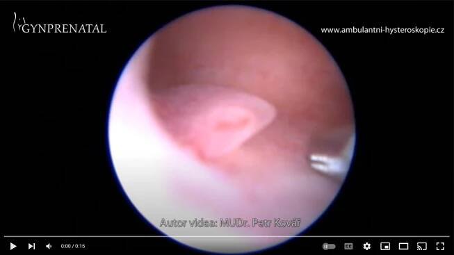 Chráněno: kapitola Endometriální polyp 