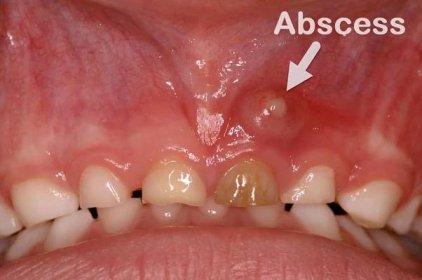 Bolest zubů s hnisem pod dásněmi (zubní absces)
