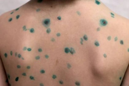 Infekce spalničkami a planými neštovicemi