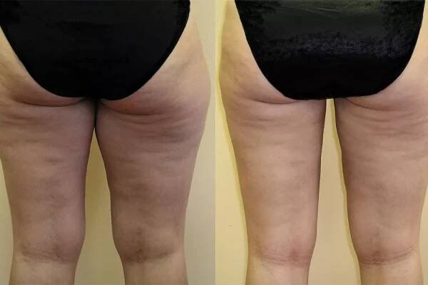 Liposukce – odsátí tuku | Liposukce – odsátí tuku | UEM
