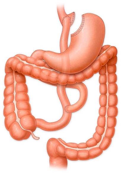 Gastric Bypass