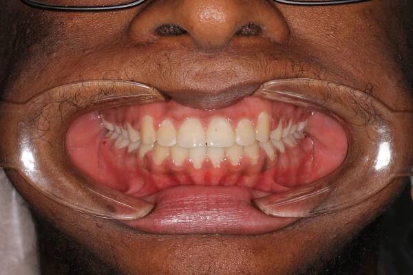 a close up of a person 's teeth with a missing tooth