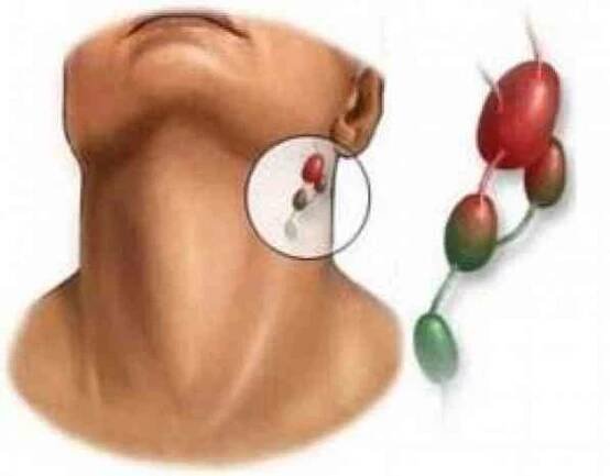 Infekční symptomy mononukleózy, diagnóza, léčba / Infekční onemocnění