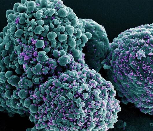 Cells infected with the omicron strain of SARS-CoV-2 Credit NIAID