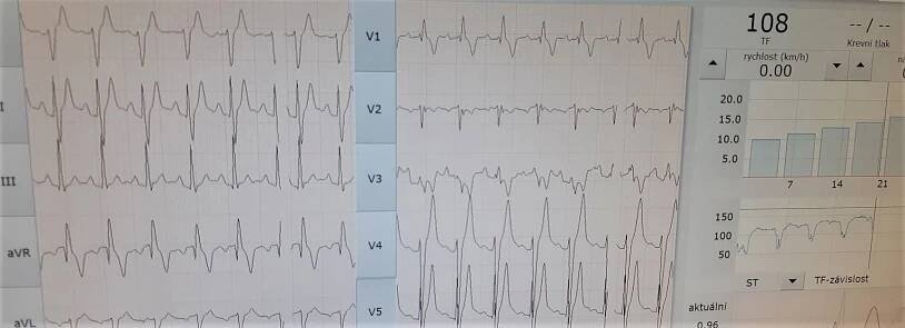 Sportovní prohlídka + zátěžové EKG :: vital