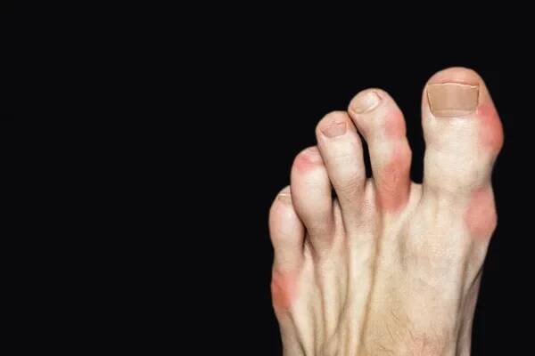 Foods That May Cause Gout - Kevin J. Powers, DPM