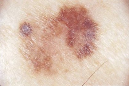 Rakovina kůže: důležité je nepropásnout počáteční stadium!