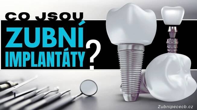 Co jsou zubní implantáty?