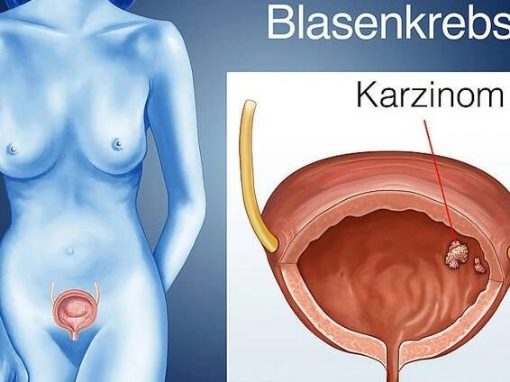 Blasenkrebs (Blasenkarzinom)