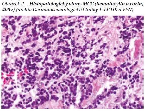Avelumab v léčbě karcinomu z Merkelových buněk - PROFI Medicína