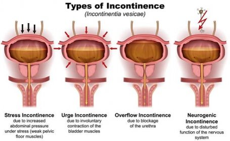 typy inkontinence 3d lékařské vektorové ilustrace na bílém pozadí s anglickým popisem - močová inkontinence stock ilustrace